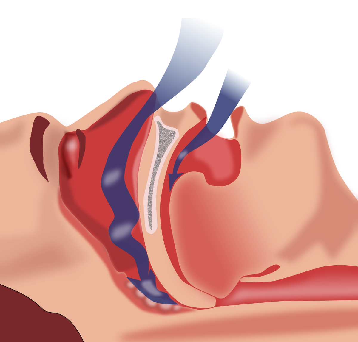 Surgical referral of obstructive sleep apnea patients- AASM Guidelines